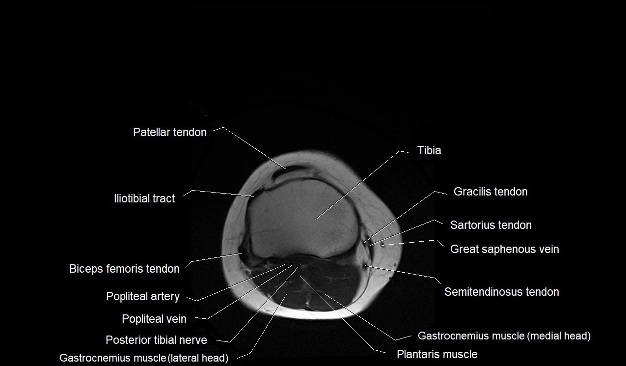MRI thigh cross sectional anatomy image 61.webp